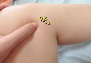 小腿水腫是什么原因引起的？教你輕松解決之道