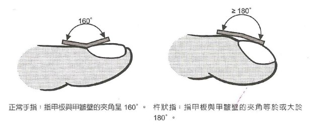 怎樣看出心臟有問題 從手指、舌頭眼神測試