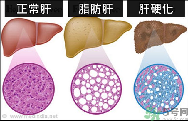 得了脂肪肝該怎么治？脂肪肝對(duì)人體危害有多大？