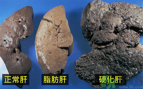 得了脂肪肝該怎么治？脂肪肝對(duì)人體危害有多大？
