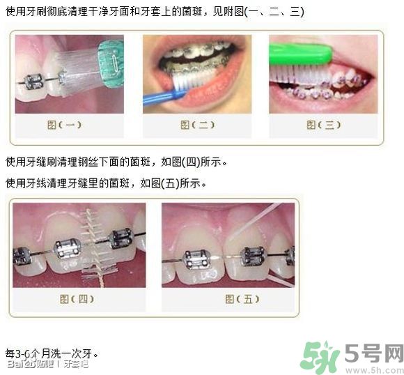 18歲還能戴牙套嗎？戴牙套真的能瘦臉改變臉型嗎？