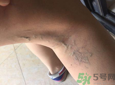 40歲女性小腿靜脈曲張?jiān)趺崔k？