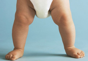 孩子一個腿長一個腿短是什么??？孩子長短腿怎么辦？