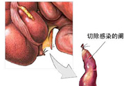 闌尾手術(shù)會(huì)影響結(jié)腸嗎？闌尾手術(shù)術(shù)后要注意什么？