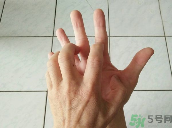 手上起水泡是什么原因？怎樣預防手上起水泡？