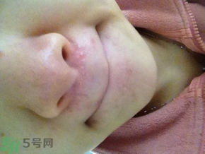 嘴巴周?chē)L(zhǎng)痘的原因是什么?嘴巴周?chē)L(zhǎng)痘怎么治療?