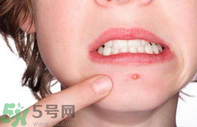 嘴巴周?chē)L(zhǎng)痘的原因是什么?嘴巴周?chē)L(zhǎng)痘怎么治療?