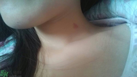 種草莓吻痕是什么意思？吻痕是怎么弄出來的？