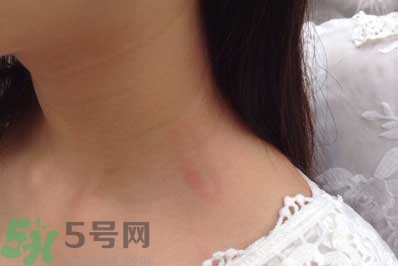 種草莓吻痕是什么意思？吻痕是怎么弄出來的？