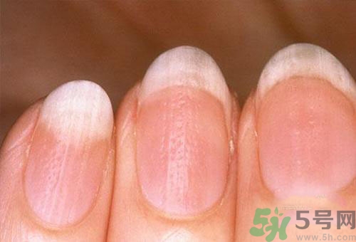 指甲發(fā)白是怎么回事？指甲發(fā)白代表什么？