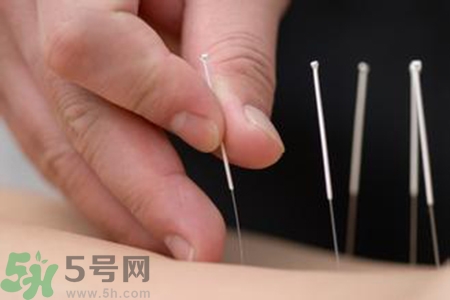 大暑可以針灸嗎？大暑針灸好不好？