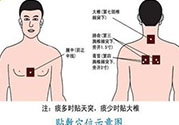 腰痛貼三伏貼有用嗎？腰痛三伏貼貼哪個(gè)穴位？