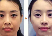 激光美白多少錢？激光美白價格