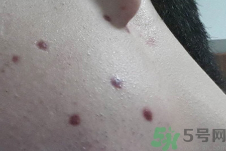 激光點痣后可以洗臉嗎？激光點痣后需要注意什么？