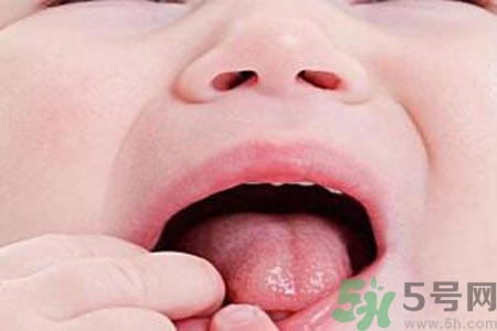 寶寶口腔潰瘍怎么辦？治療寶寶口腔潰瘍方法有什么？