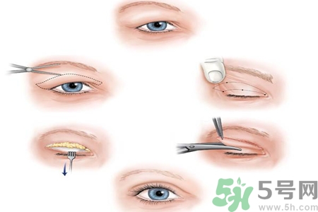 割雙眼皮分哪幾種？割雙眼皮需要多少錢？