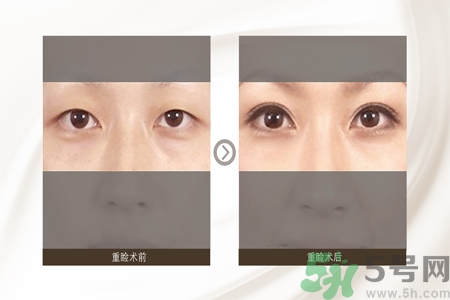割雙眼皮分哪幾種？割雙眼皮需要多少錢？