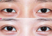 割雙眼皮分哪幾種？割雙眼皮需要多少錢？