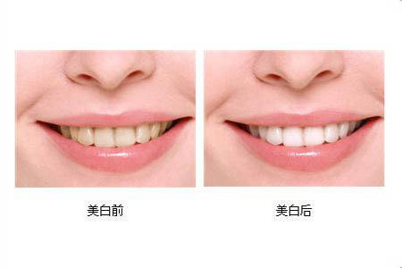 冷光美白牙齒可以保持多長時間？冷光美白牙齒有副作用嗎？