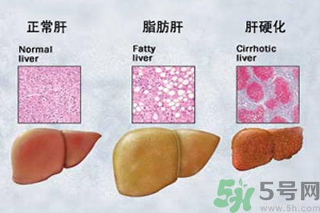 妊娠急性脂肪肝是什么？妊娠急性脂肪肝的治療方法？