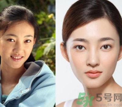 開眼角眼睛會(huì)變大嗎？開眼角眼睛能大多少？