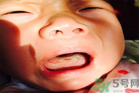 舌頭燙傷后該怎么辦呢？舌頭燙傷后應(yīng)該注意吃什么？?