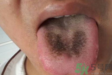 舌頭發(fā)黑怎么回事？舌頭發(fā)黑怎么辦？