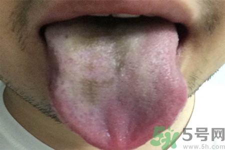 舌頭發(fā)黑怎么回事？舌頭發(fā)黑怎么辦？