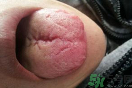 舌頭上有裂紋是怎么辦？舌頭上有裂紋是什么原因？