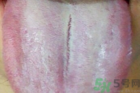 舌頭發(fā)白是什么原因？舌苔發(fā)白是怎么辦？