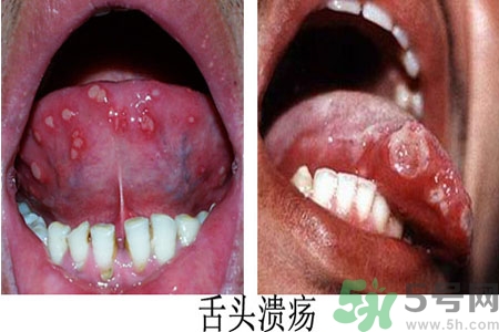 舌頭潰瘍怎么辦？舌頭潰瘍的原因？