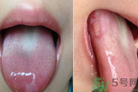 舌頭潰瘍怎么辦？舌頭潰瘍的原因？