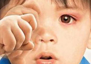寶寶得了紅眼病怎么辦？寶寶得了紅眼病怎么治？