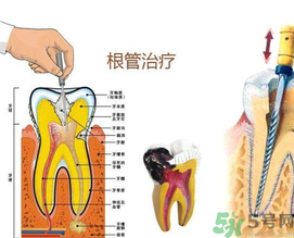 什么是根管治療？為什么牙齒疼要做根管治療？