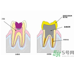 什么是根管治療？為什么牙齒疼要做根管治療？