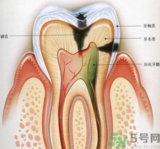 什么是根管治療？為什么牙齒疼要做根管治療？
