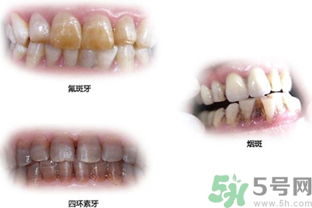 四環(huán)素牙是什么？四環(huán)素牙是怎么形成的？