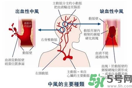 腦中風(fēng)是什么？腦中風(fēng)的癥狀？