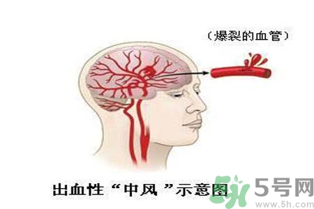 腦中風(fēng)的護(hù)理措施？腦中風(fēng)的飲食護(hù)理？