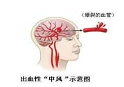 腦中風的發(fā)病因素？腦中風的并發(fā)癥有哪些 ？