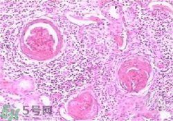 慢性腎炎能治好嗎？慢性腎炎能活多久？