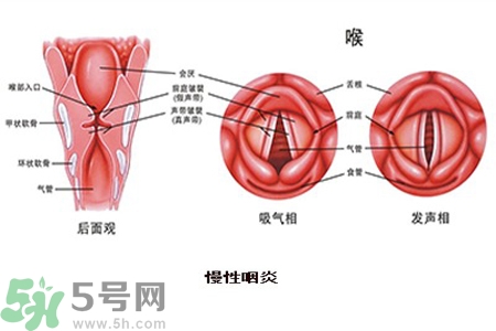 慢性咽炎是什么？慢性咽炎的癥狀有哪些？