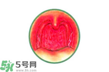 慢性咽炎的治療方法？慢性咽炎的藥物治療？