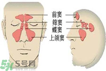 鼻竇炎是什么？鼻竇炎的癥狀有哪些？
