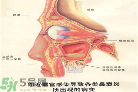 鼻竇炎是什么？鼻竇炎的癥狀有哪些？