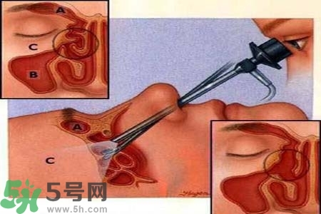 鼻竇炎的高發(fā)人群？如何預(yù)防鼻竇炎？