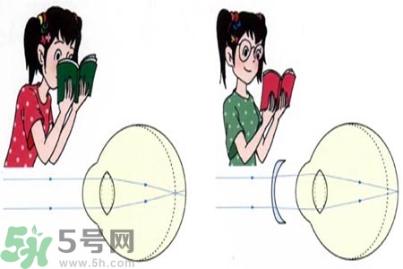 近視眼的發(fā)病因素？近視眼的并發(fā)癥有哪些？