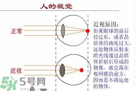 近視眼高發(fā)人群？如何預(yù)防近視眼？