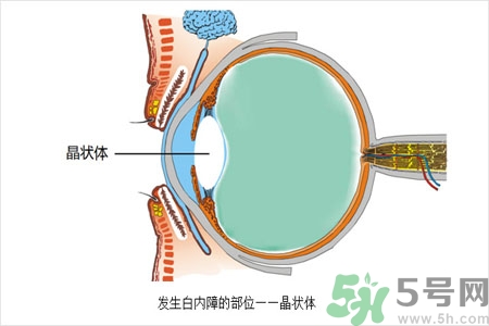 白內(nèi)障的護(hù)理措施是什么？白內(nèi)障的飲食護(hù)理有哪些？