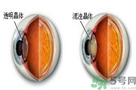 白內(nèi)障治療方法是什么？白內(nèi)障可以用什么藥物治療？